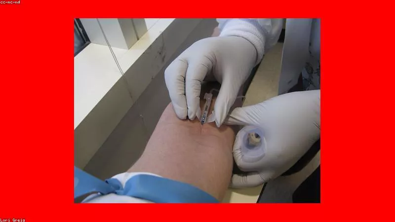 Phân tích y khoa hình ảnh Những dấu hiệu quá liều Prednisolone và cách xử trí khẩn cấp
